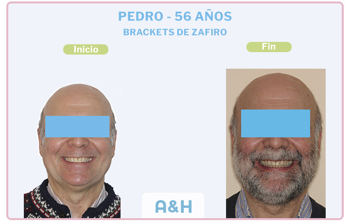 Pedro, 56 años – Brackets de Zafiro