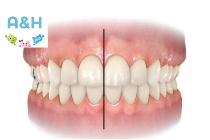 La línea media dentaria: Una clave en la estética de la sonrisa