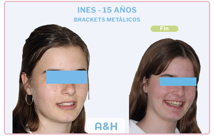 Ines, tratamiento con Brackets Metálicos