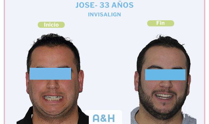 Jose, tratamiento con Invisalign