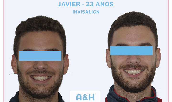 Javier, 23 años, tratamiento con Invisalign