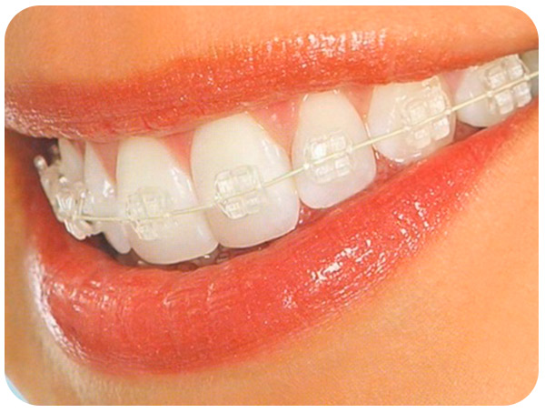 brackets-zafiro