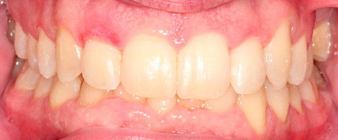 blanqueamiento dental alba y hernanz