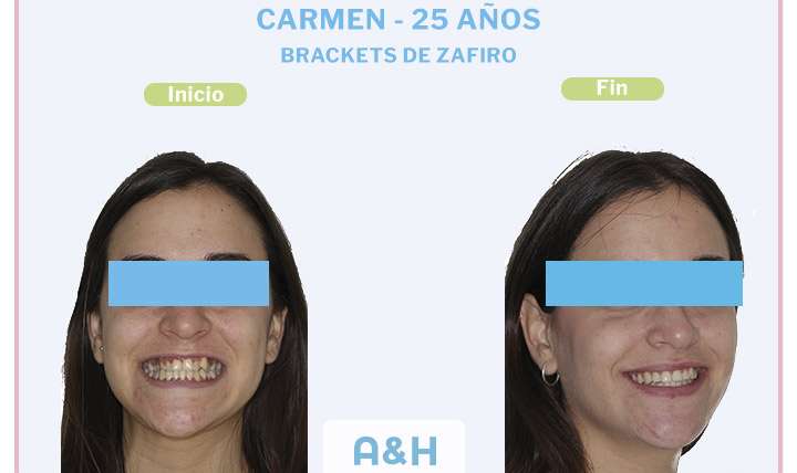 Carmen, 25 años, Brackets de Zafiro