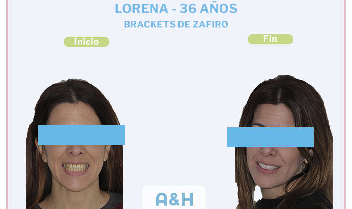 Maria, 22 años, Brackets de Autoligado Damon