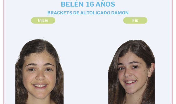 Maria Belén, 16 años, Brackets de Autoligado Damon