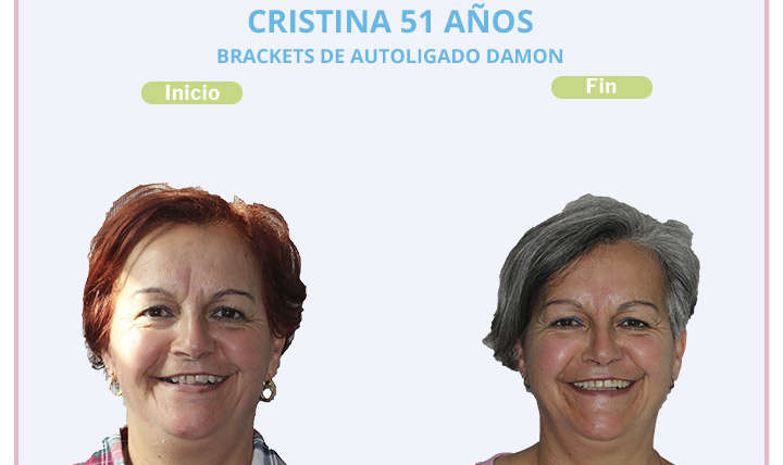 Cristina, 51 años, Brackets de autoligado damon