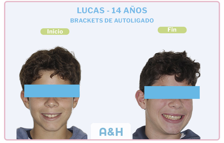 Lucas, 14 años, Brackets de autoligado damon