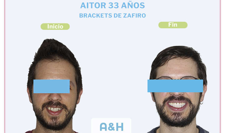 Aitor, 33 años, Brackets de zafiro