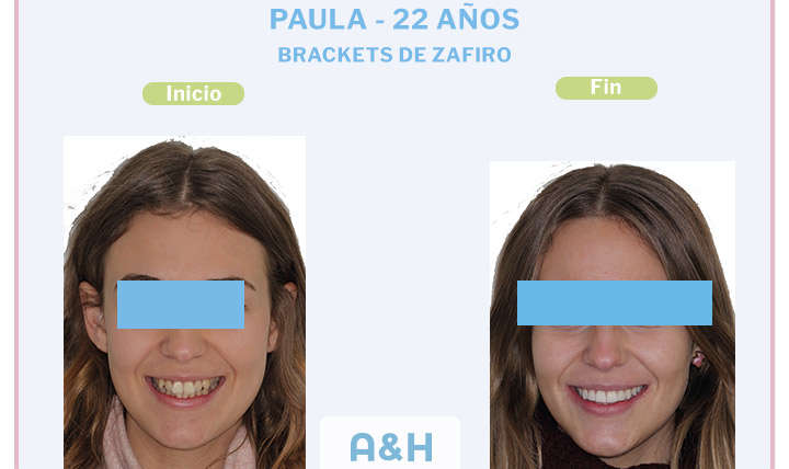 Paula, 22 años, Brackets de zafiro