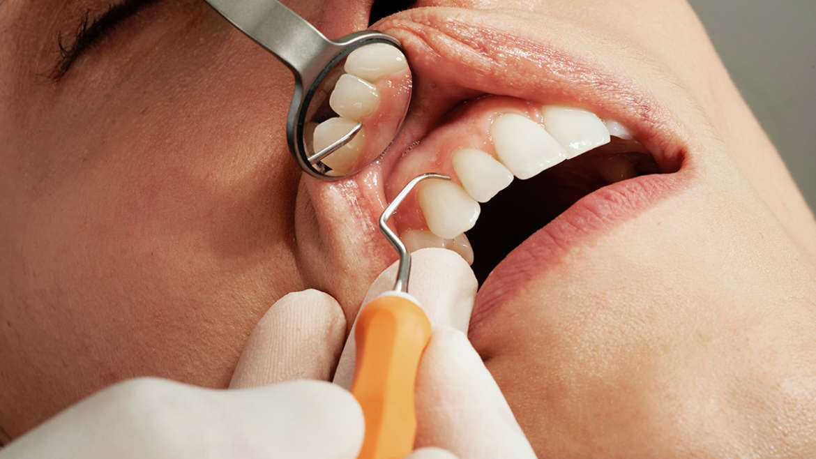 Gingivitis y Ortodoncia. ¿Cómo ayuda la Ortodoncia a evitar las encías inflamadas?