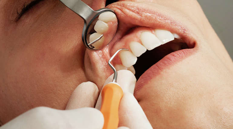 Gingivitis y Ortodoncia. ¿Cómo ayuda la Ortodoncia a evitar las encías inflamadas?