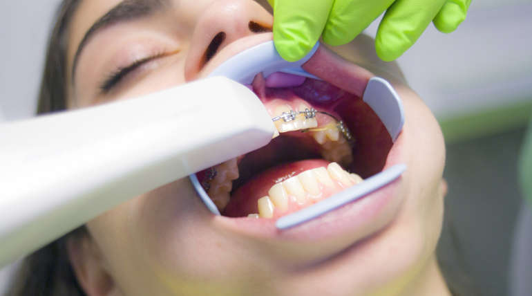 Luxación Dental
