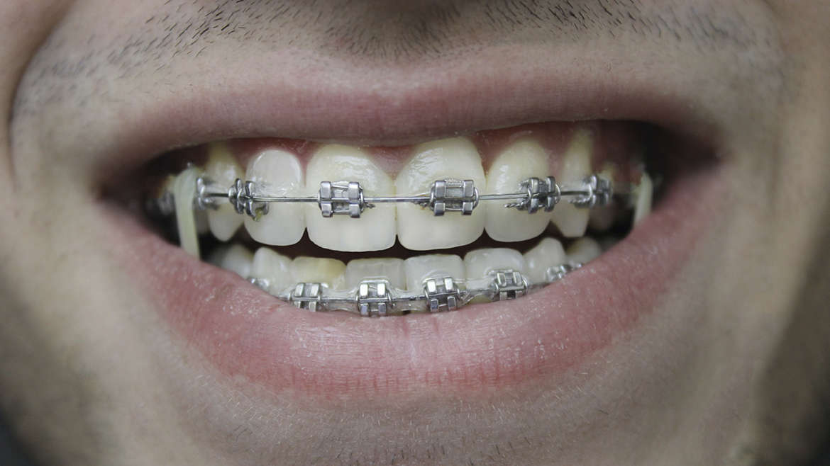 ¿Puedo llevar Ortodoncia si tengo implantes dentales?