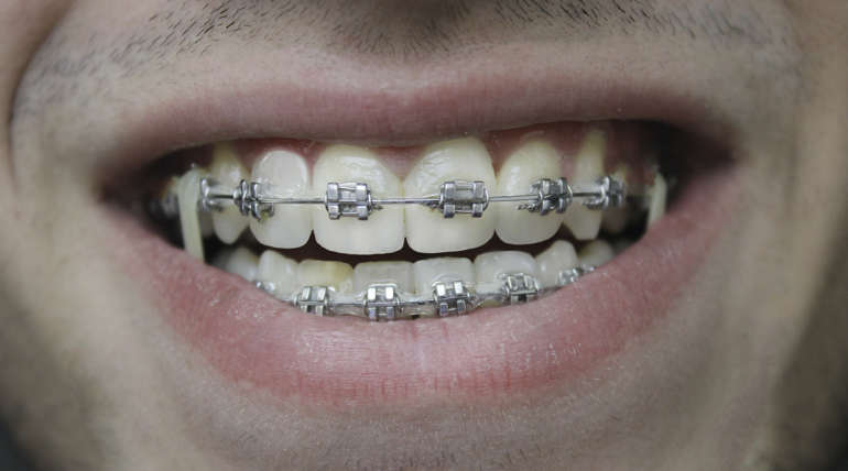 ¿Puedo llevar Ortodoncia si tengo implantes dentales?