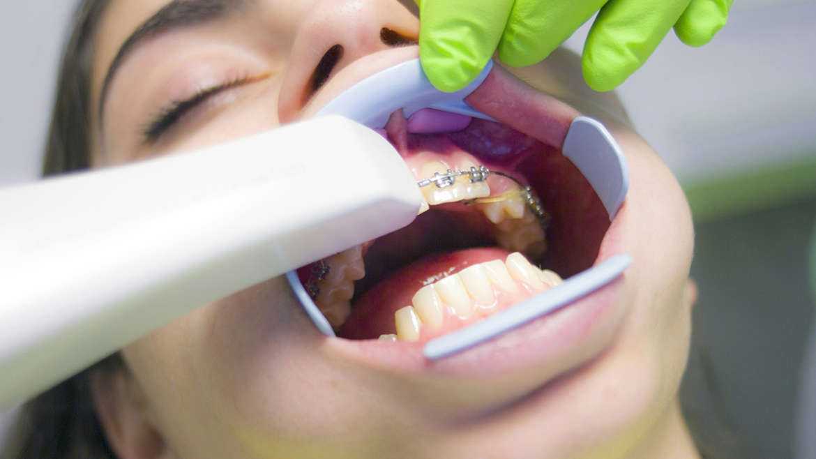 ¿Qué beneficios tiene la Ortodoncia en dientes apiñados?