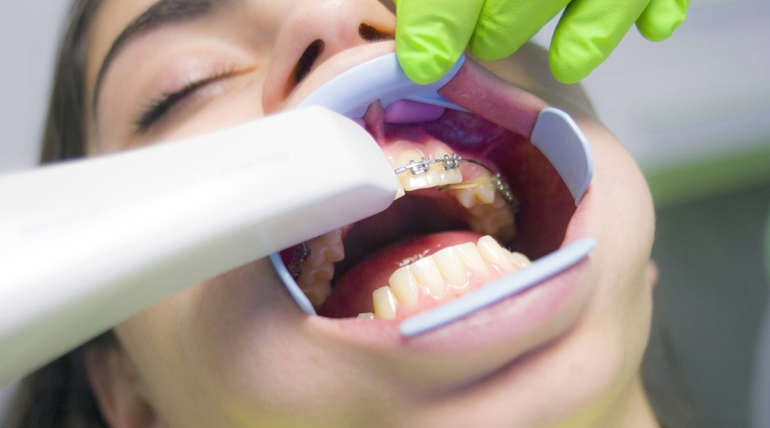 ¿Qué beneficios tiene la Ortodoncia en dientes apiñados?