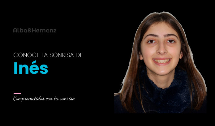 Inés, 15 años, Disyuntor Maxilar + Brackets de autoligado Damon