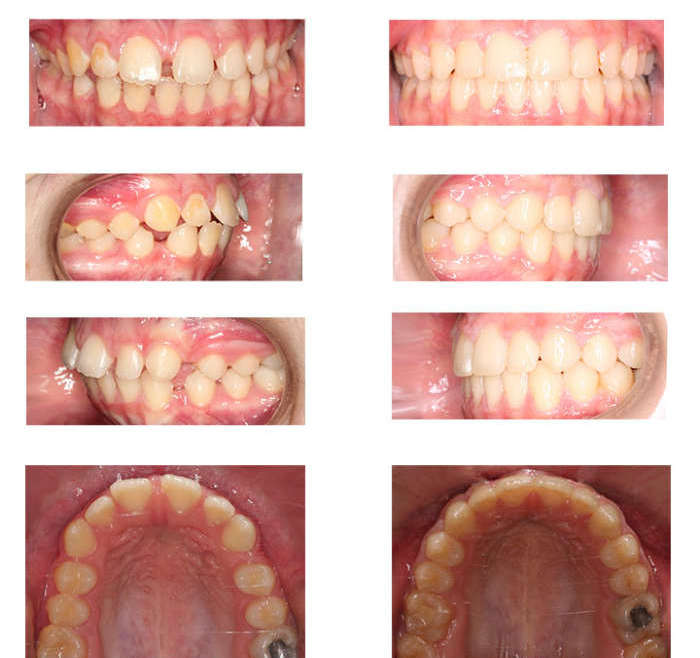 Paula, 19 años, Brackets de zafiro + Quad Helix