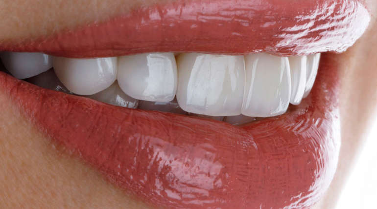 ¿Cuándo debo realizarme un blanqueamiento dental?
