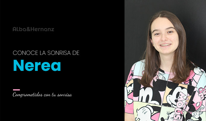 Nerea, 18 años, Brackets de autoligado Damon + Microtornillo