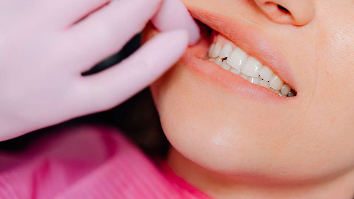 Mitos y realidades sobre el blanqueamiento dental