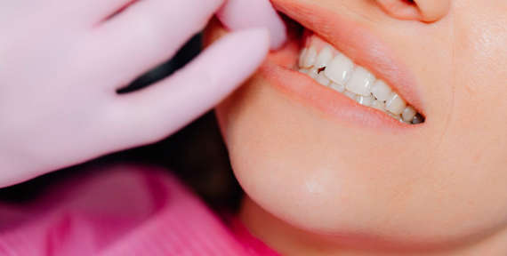 Mitos y realidades sobre el blanqueamiento dental
