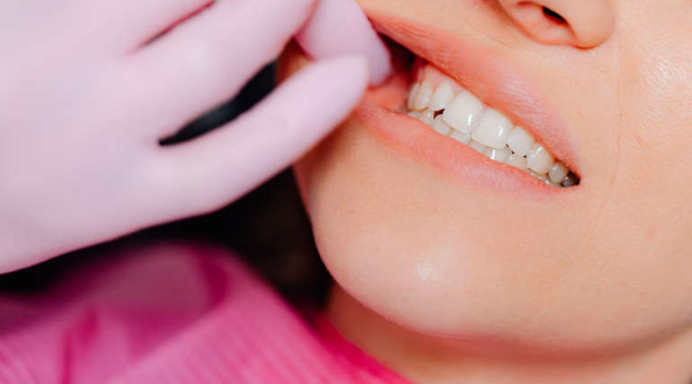 Mitos y realidades sobre el blanqueamiento dental