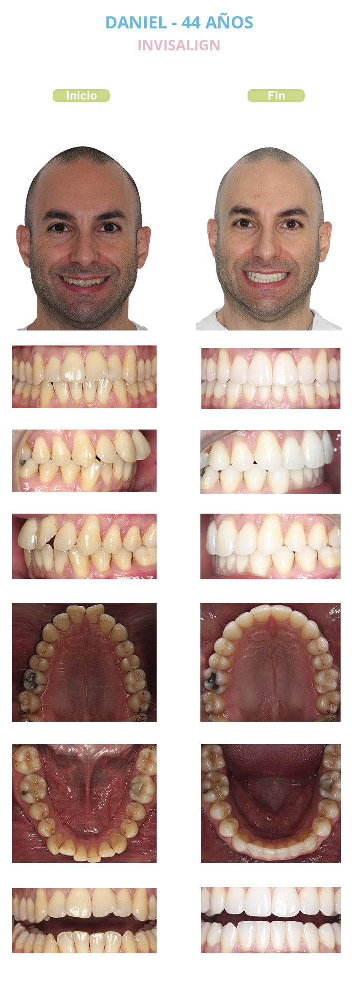 daniel 44 invisalign