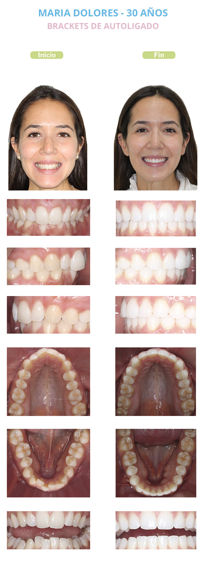 maria dolores brackets autoligado