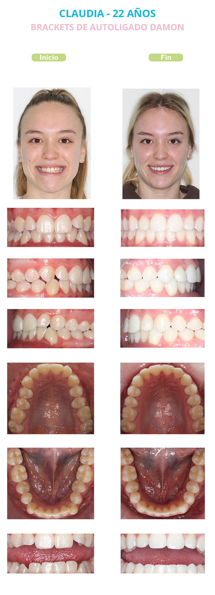 claudia dientes antes y despues