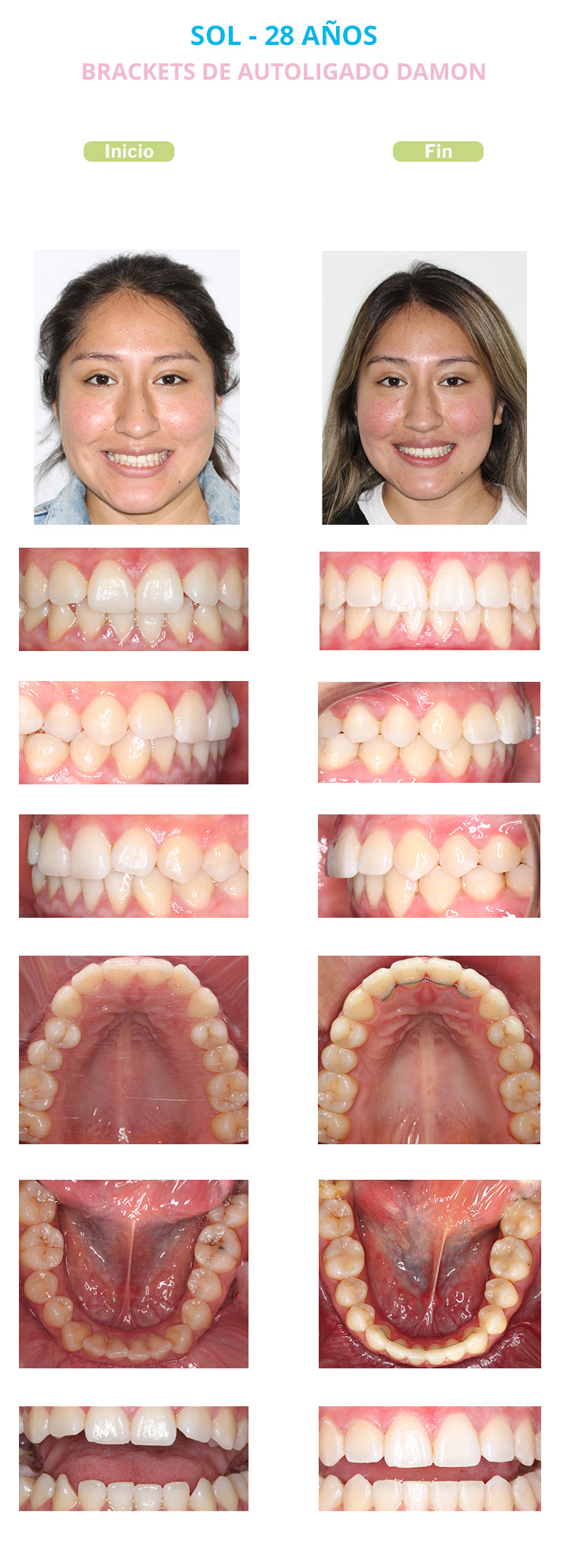 sol dientes antes y despues