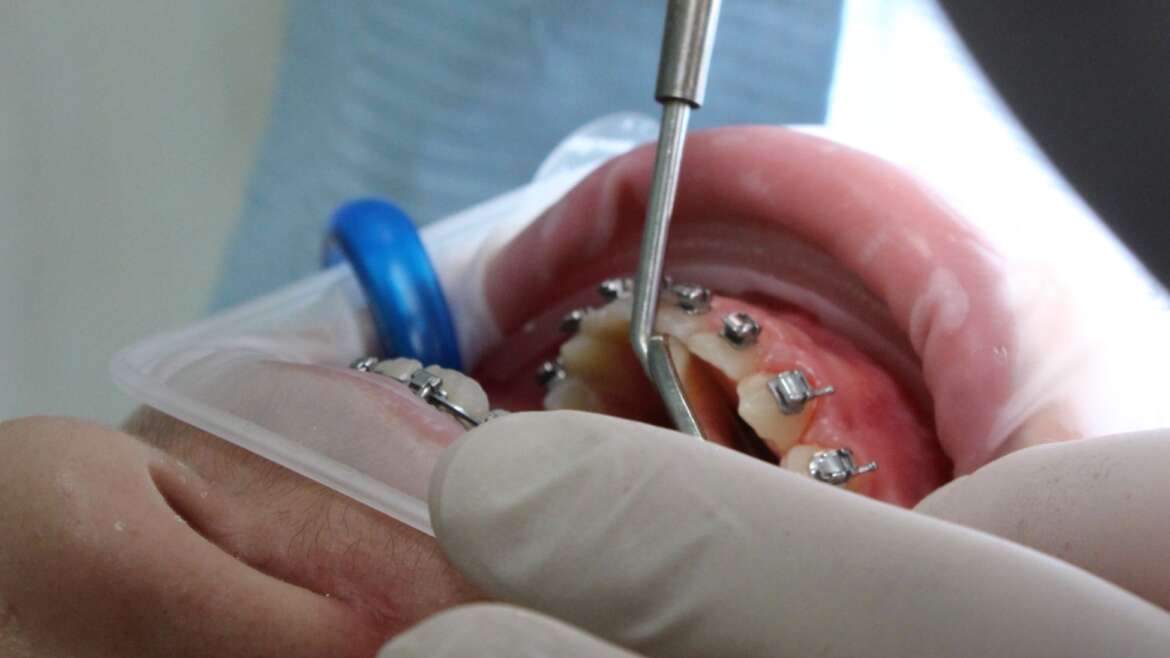 ¿De qué están hechos los brackets?