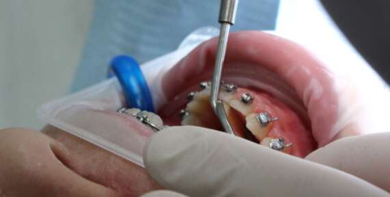 ¿De qué están hechos los brackets?
