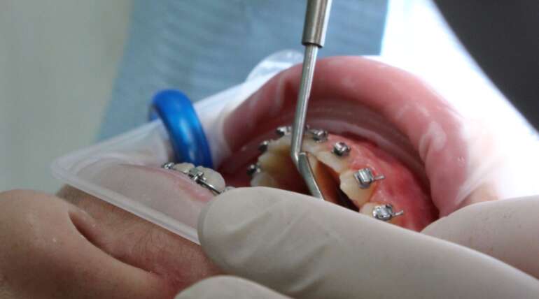 ¿De qué están hechos los brackets?