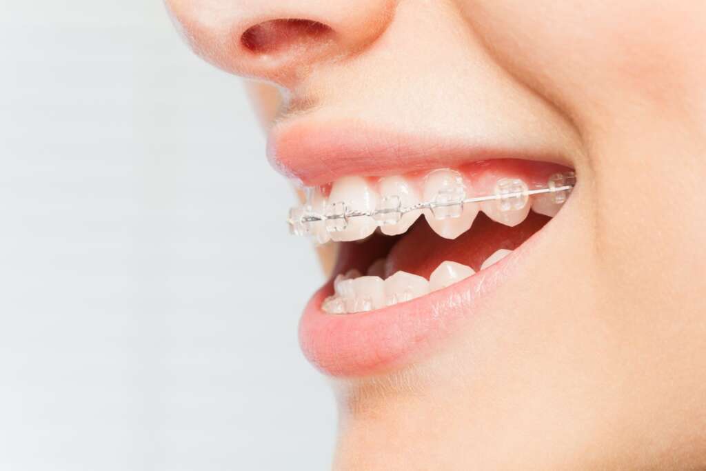 brackets de zafiro