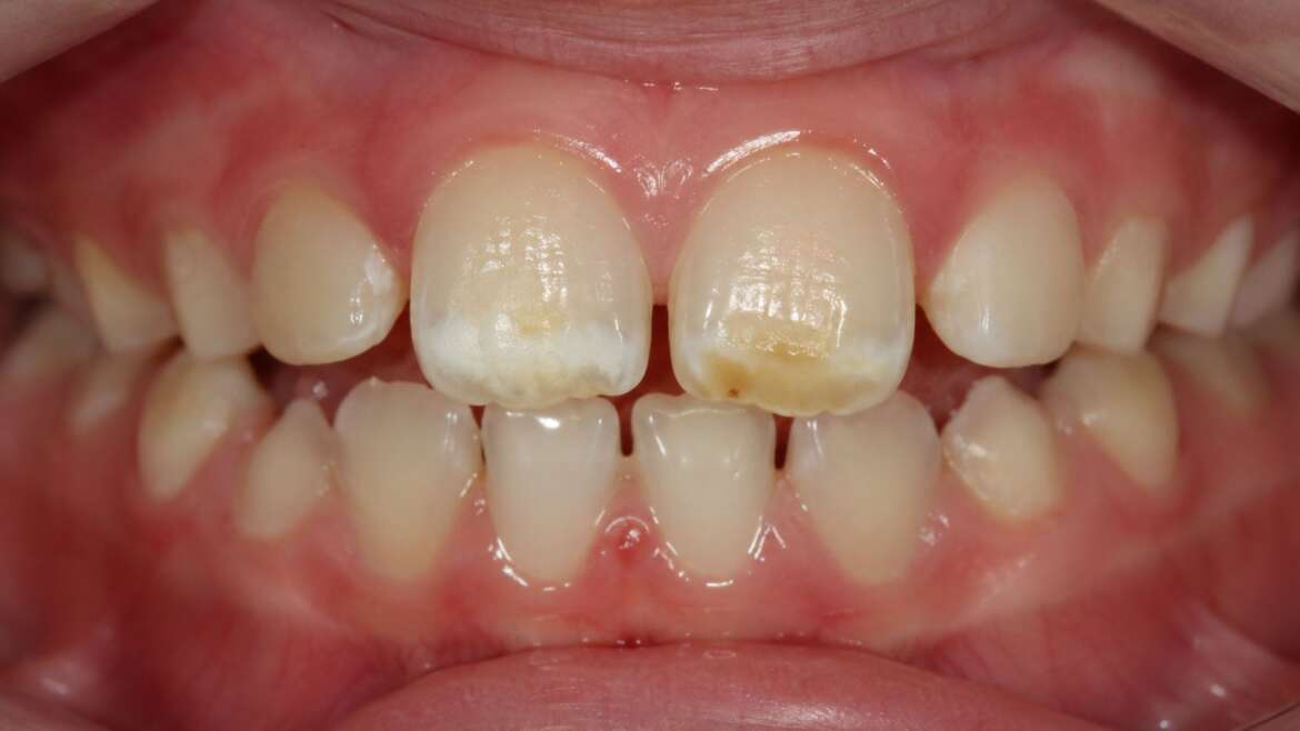 ¿Manchas blancas o amarillas en los dientes de tu hijo? Puede ser hipomineralización
