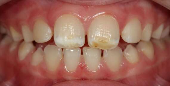 ¿Manchas blancas o amarillas en los dientes de tu hijo? Puede ser hipomineralización