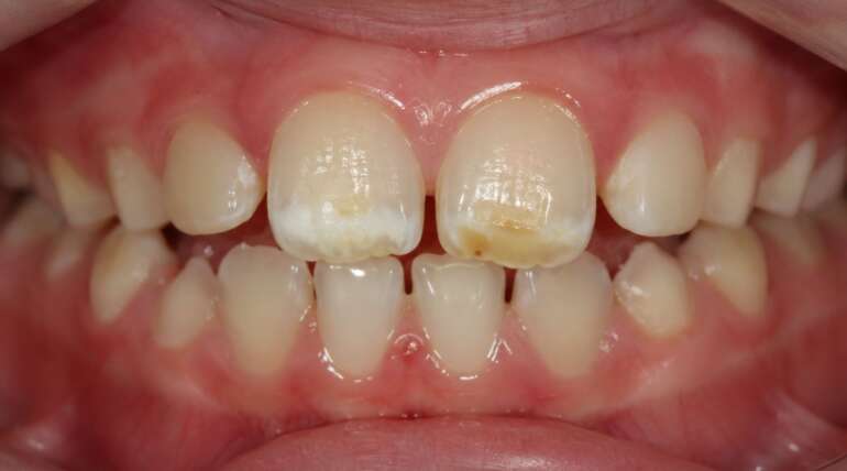 ¿Manchas blancas o amarillas en los dientes de tu hijo? Puede ser hipomineralización