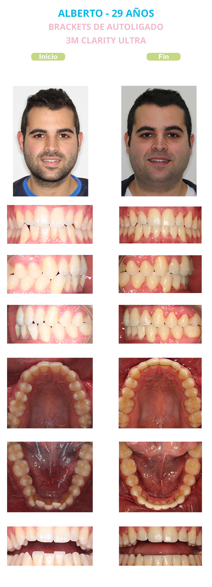 antes y despues de brackets autoligado 3m clarity ultra alberto