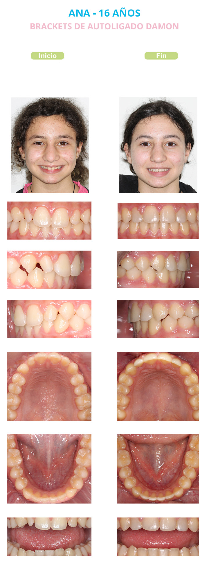 antes y despues de brackets autoligado damon ana