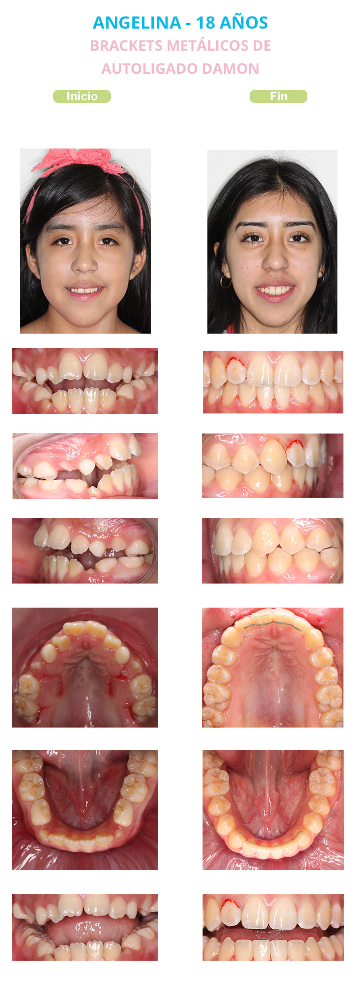 antes y despues de brackets metalicos de autoligado angelina