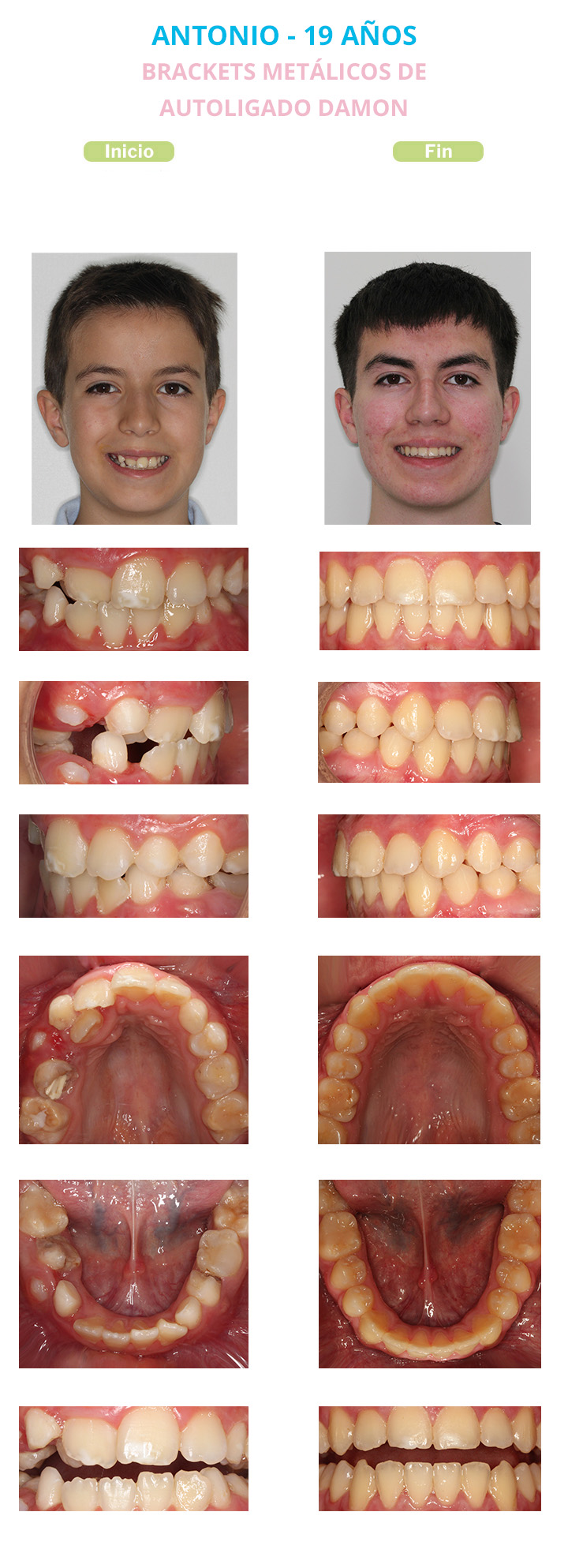 antes y despues de brackets metalicos de autoligado damon antonio