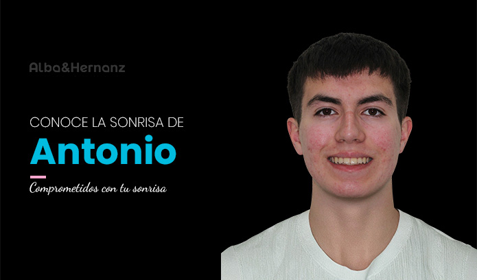Antonio, 19 años, Brackets metálicos de Autoligado Damon