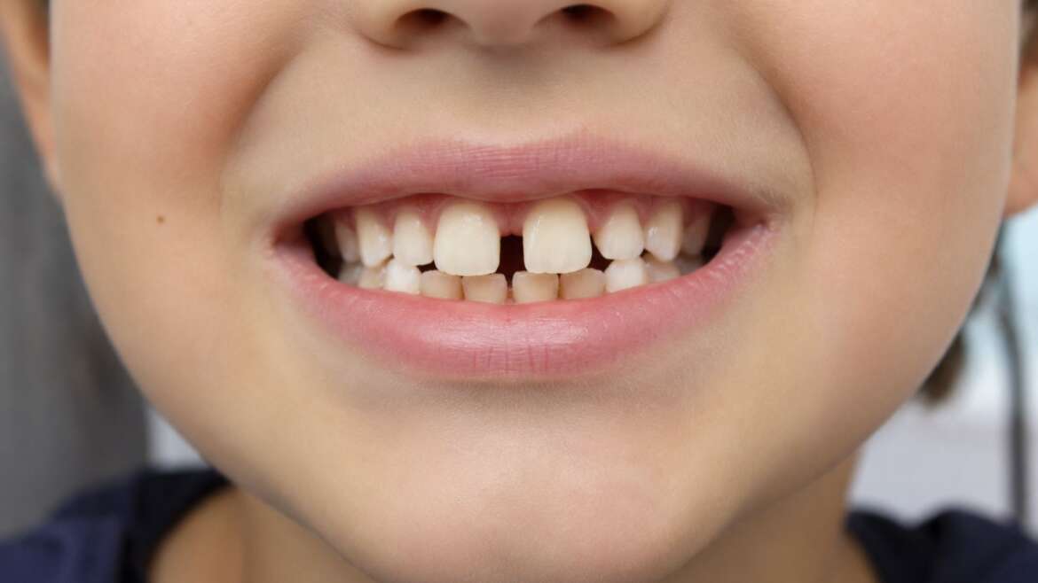Mi hijo tiene los dientes separados: ¿se juntarán solos?