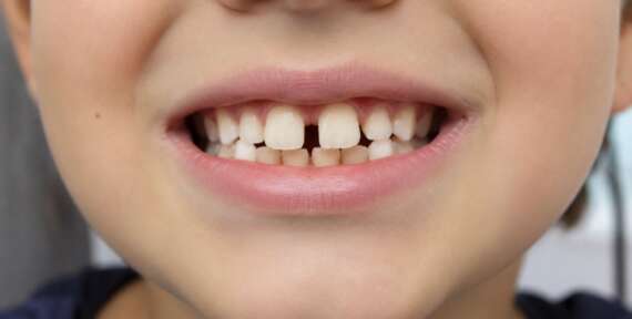 Mi hijo tiene los dientes separados: ¿se juntarán solos?