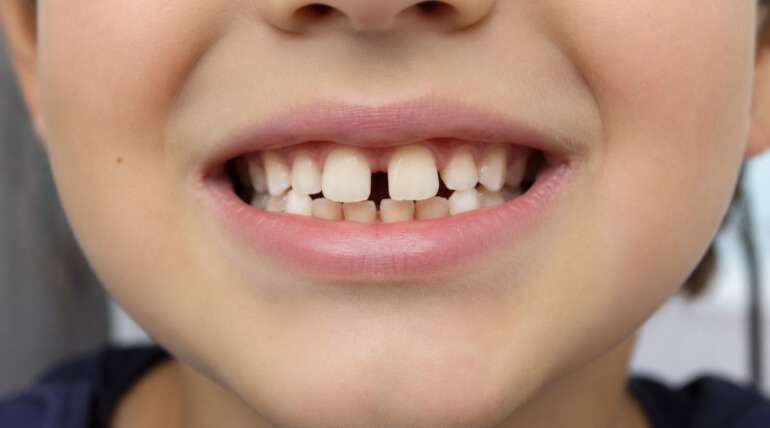 Mi hijo tiene los dientes separados: ¿se juntarán solos?