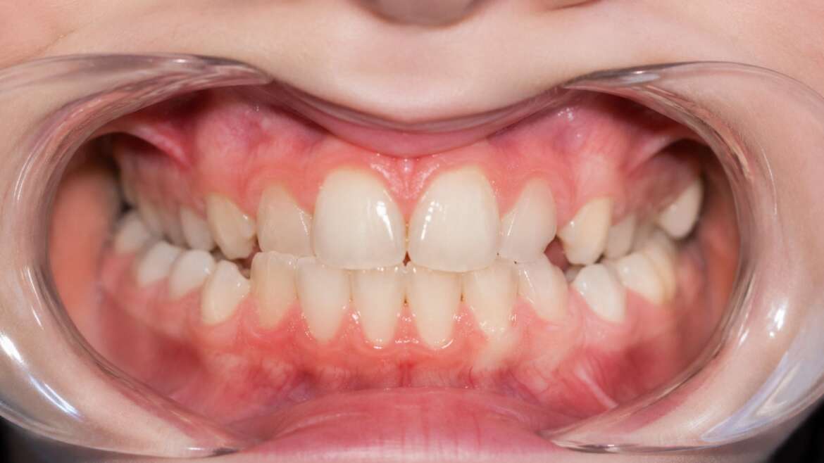 Tipos de mordida: cómo afectan a tu sonrisa y a la salud de tu boca