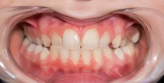 Tipos de mordida: cómo afectan a tu sonrisa y a la salud de tu boca