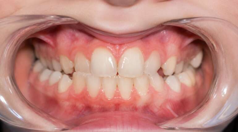 Tipos de mordida: cómo afectan a tu sonrisa y a la salud de tu boca